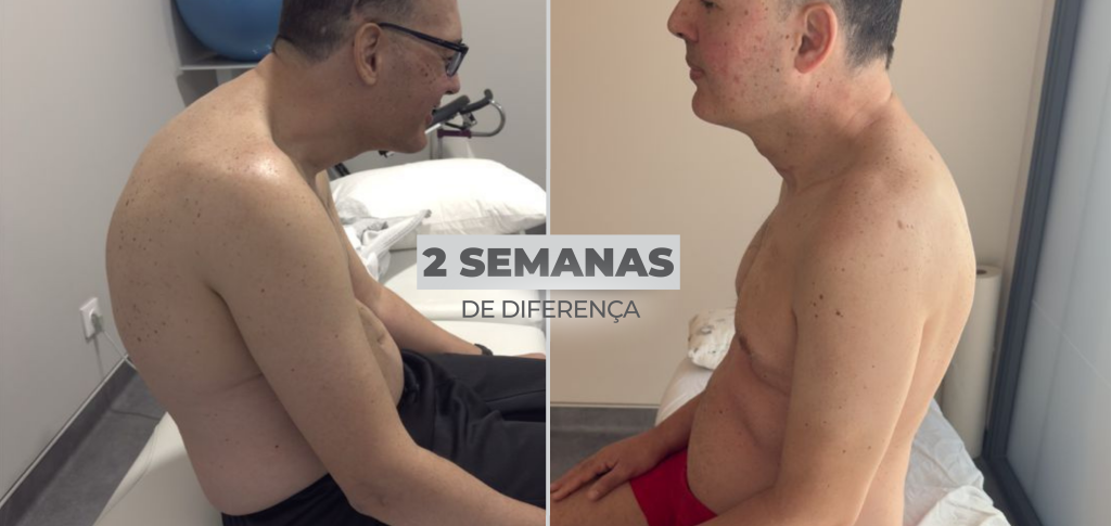 Em apenas duas semanas de fisioterapia neurofuncional, o paciente com epilepsia e lobectomia apresentou melhora significativa da postura, evidenciando a importância de tratamentos personalizados e baseados em evidência.